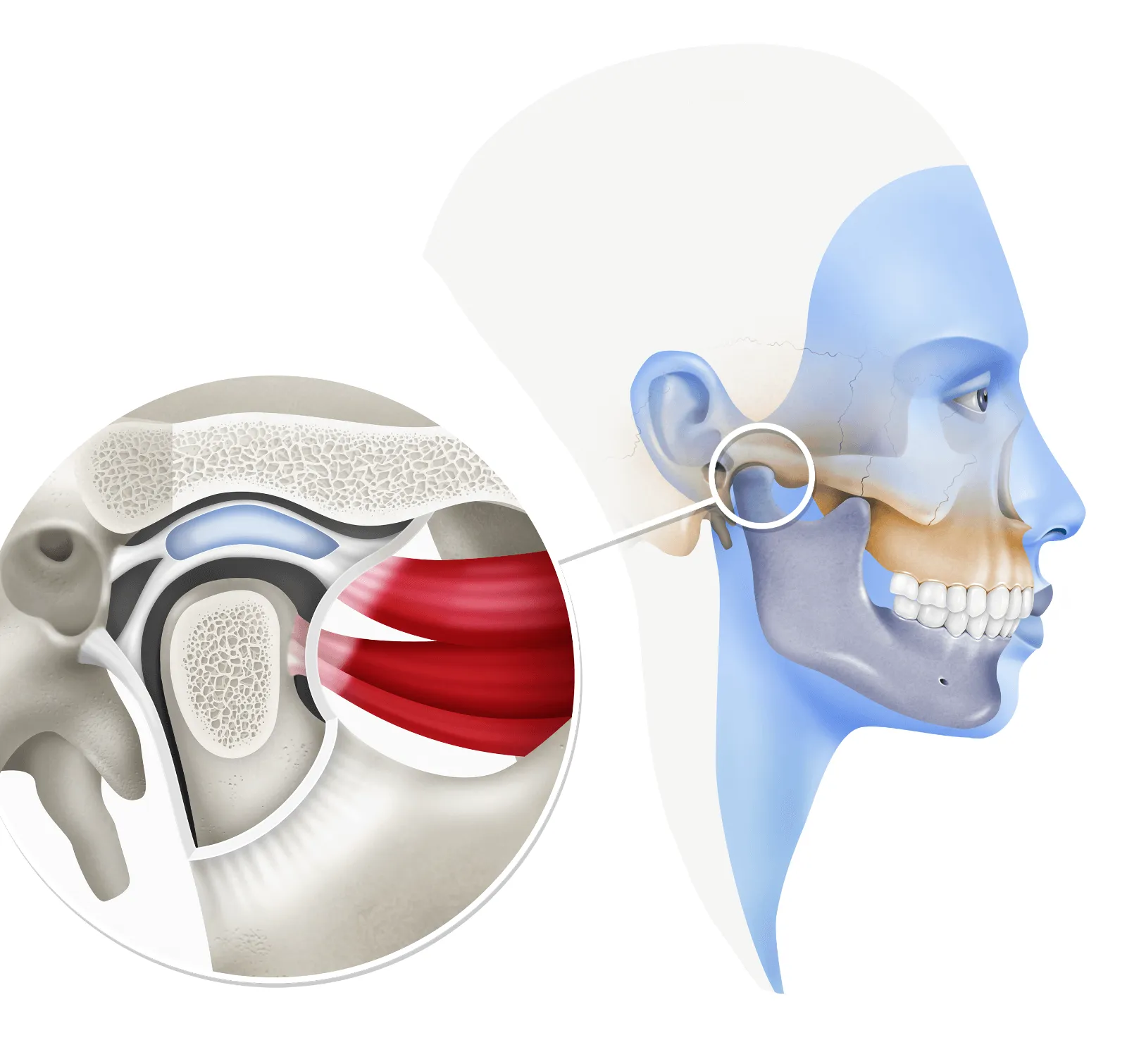 Artrosis de la articulación temporomandibular