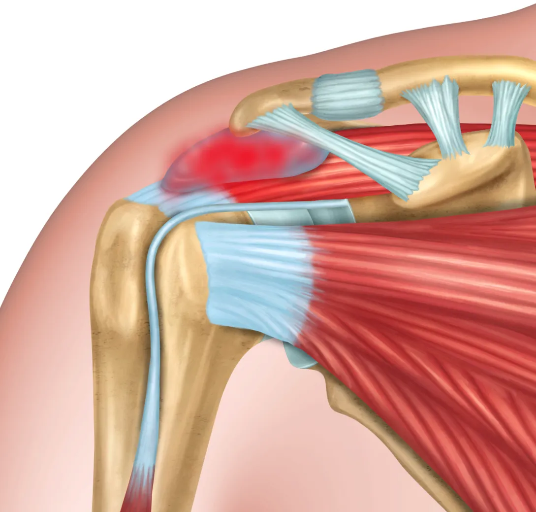 Bursitis de Hombro