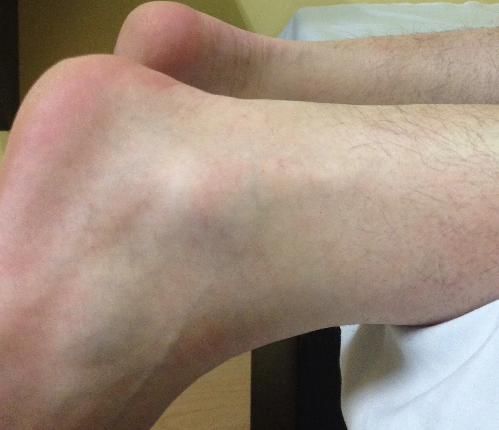 Bursitis en el Tobillo