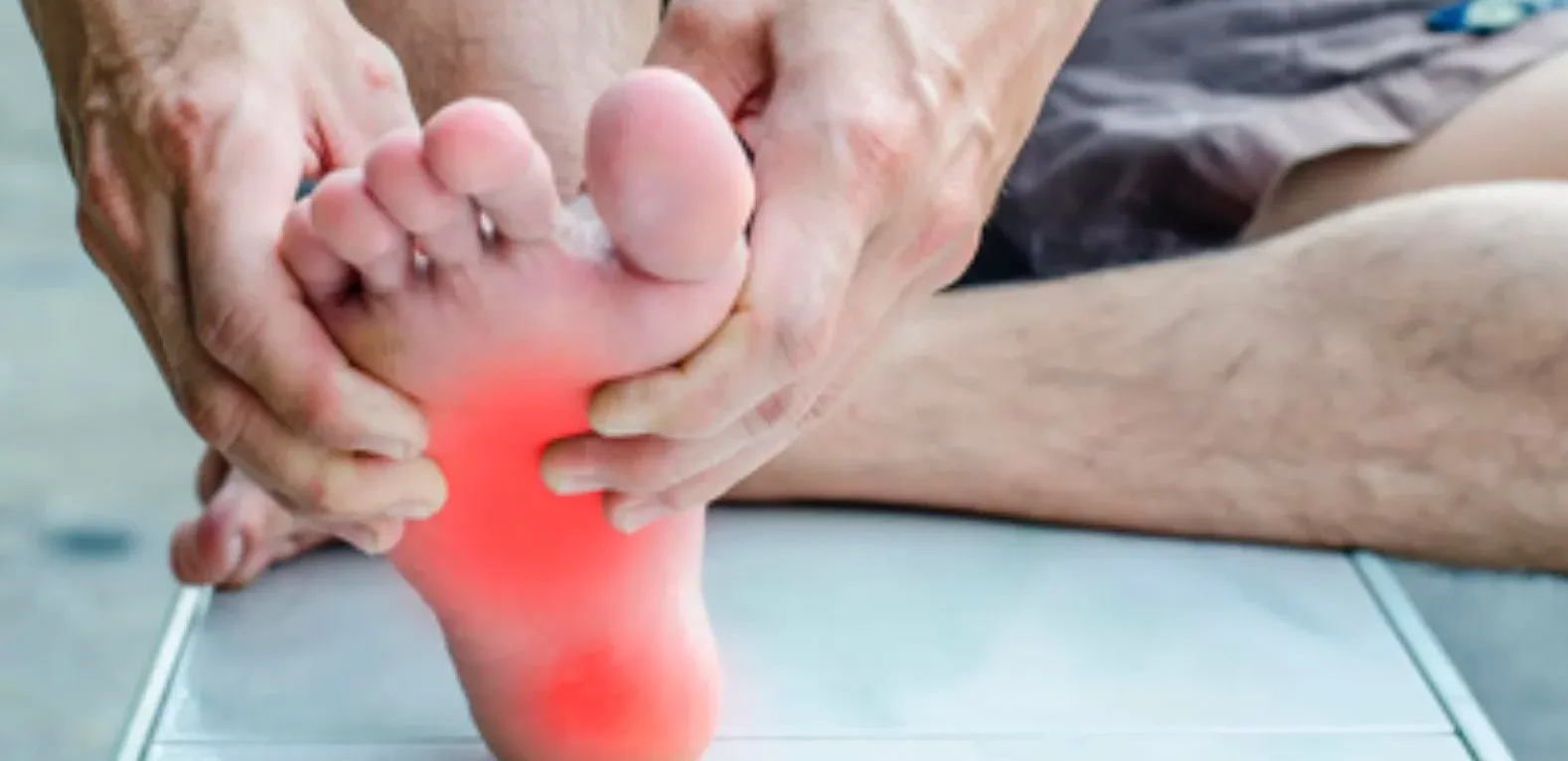 Fascitis Plantar (Dolor referido en la Pantorrilla)