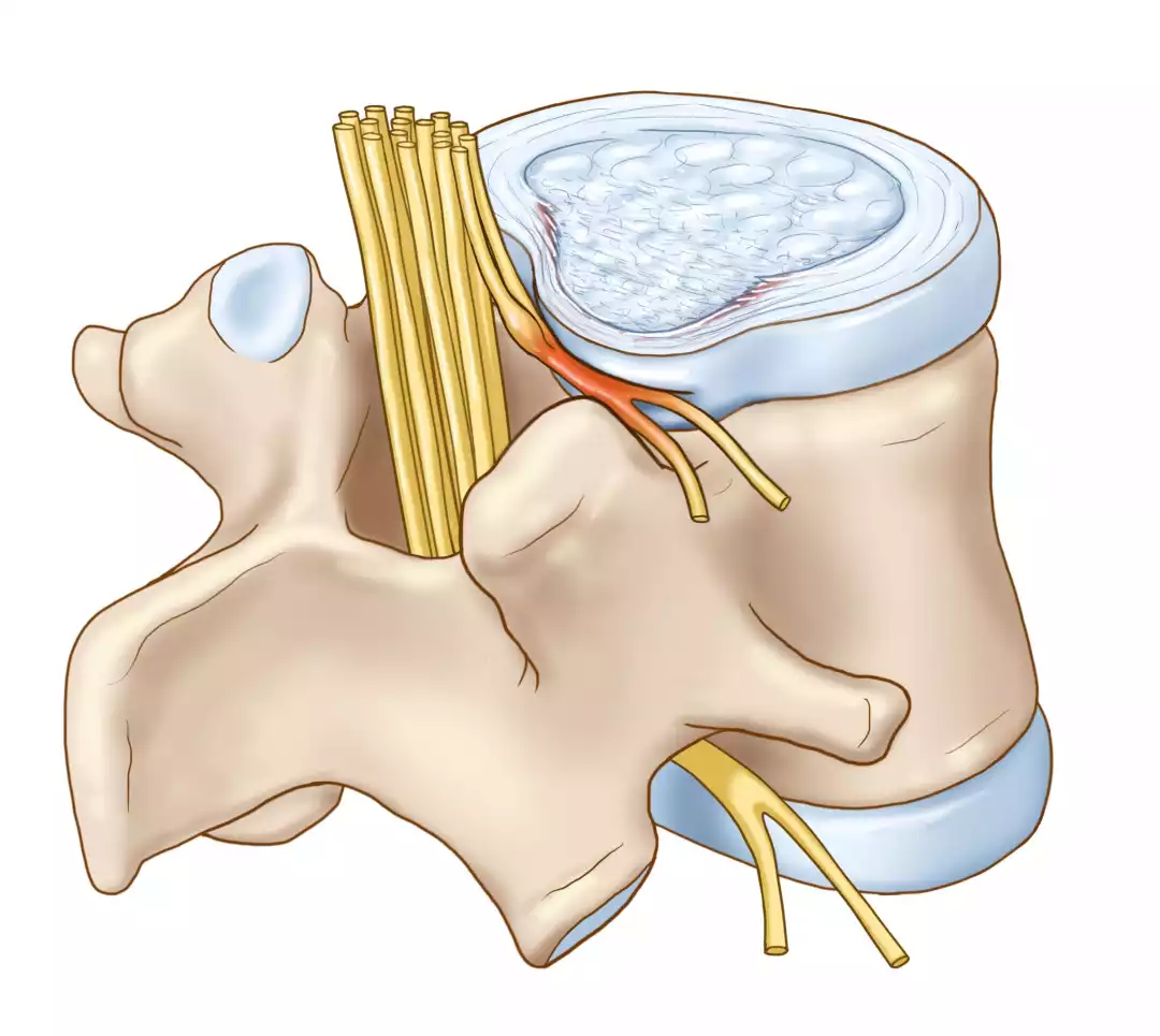 Lipedema: Entendiendo tus Piernas