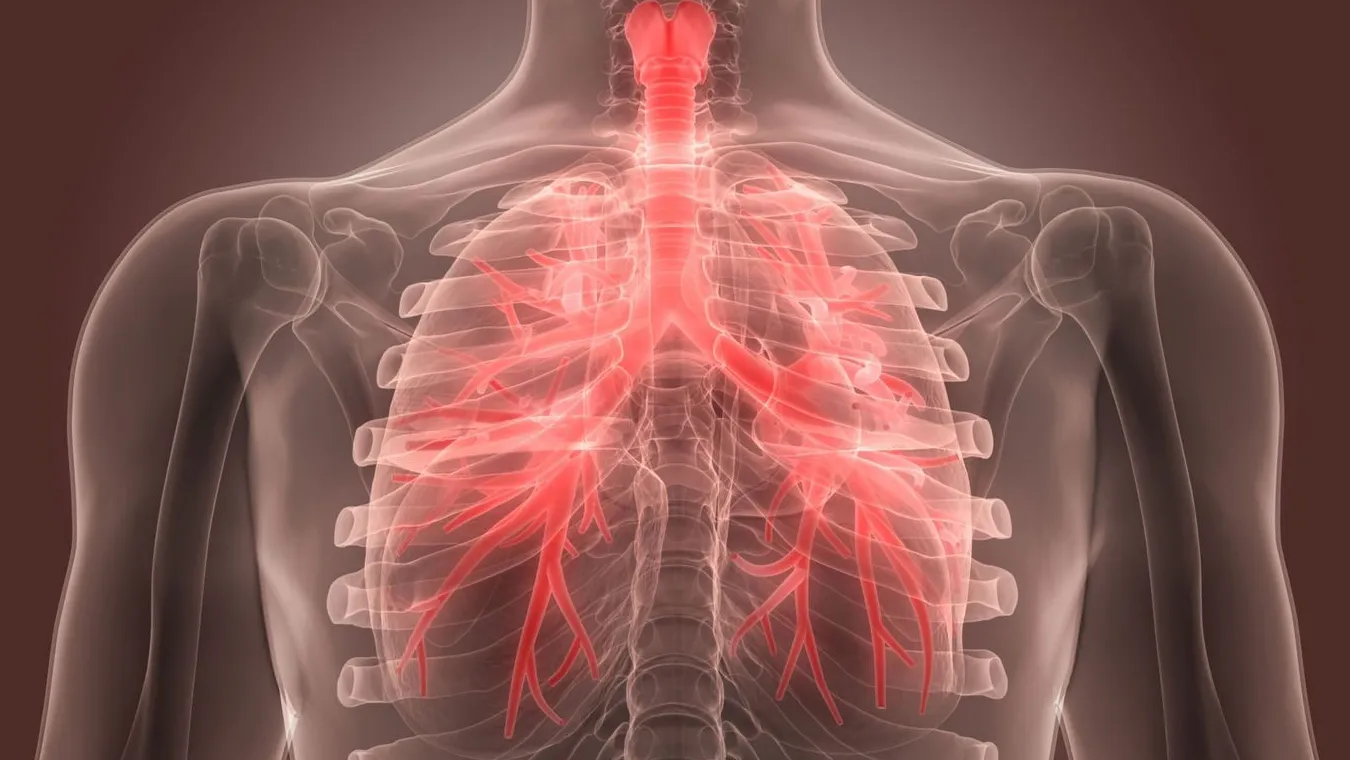 Bronquitis Crónica y Aguda