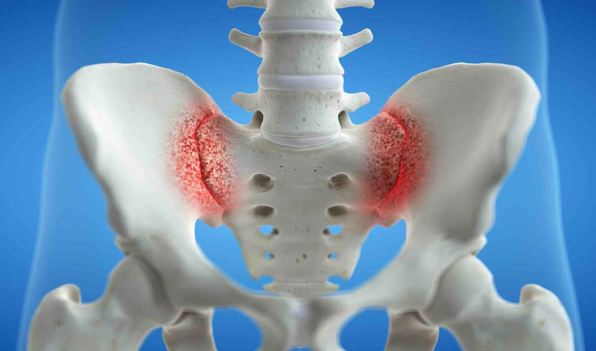 Dolor en la Articulación Sacroilíaca