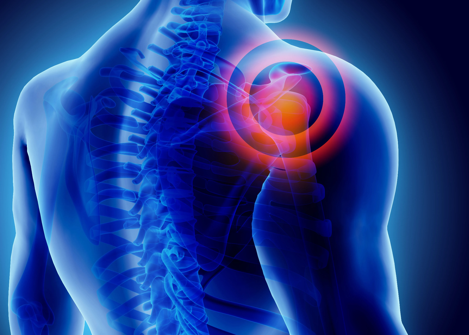 Dolor Miofascial en el Área del Hombro