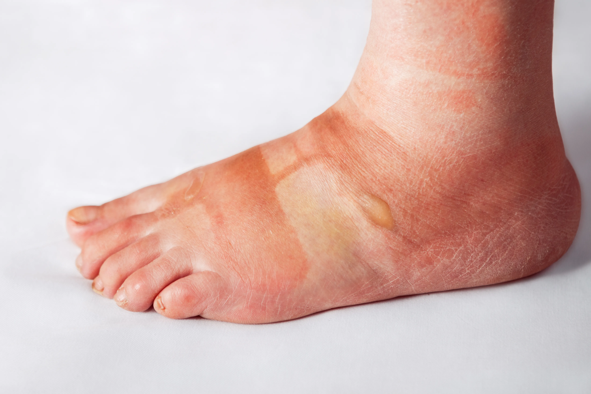 Edema o Hinchazón en el Tobillo