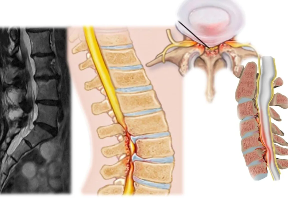 Estenosis de la Arteria Vertebral