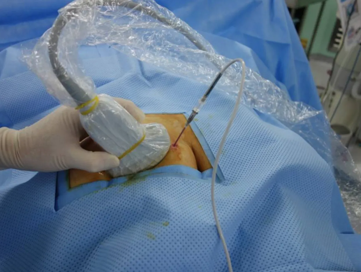 Neuralgia del Pudendo