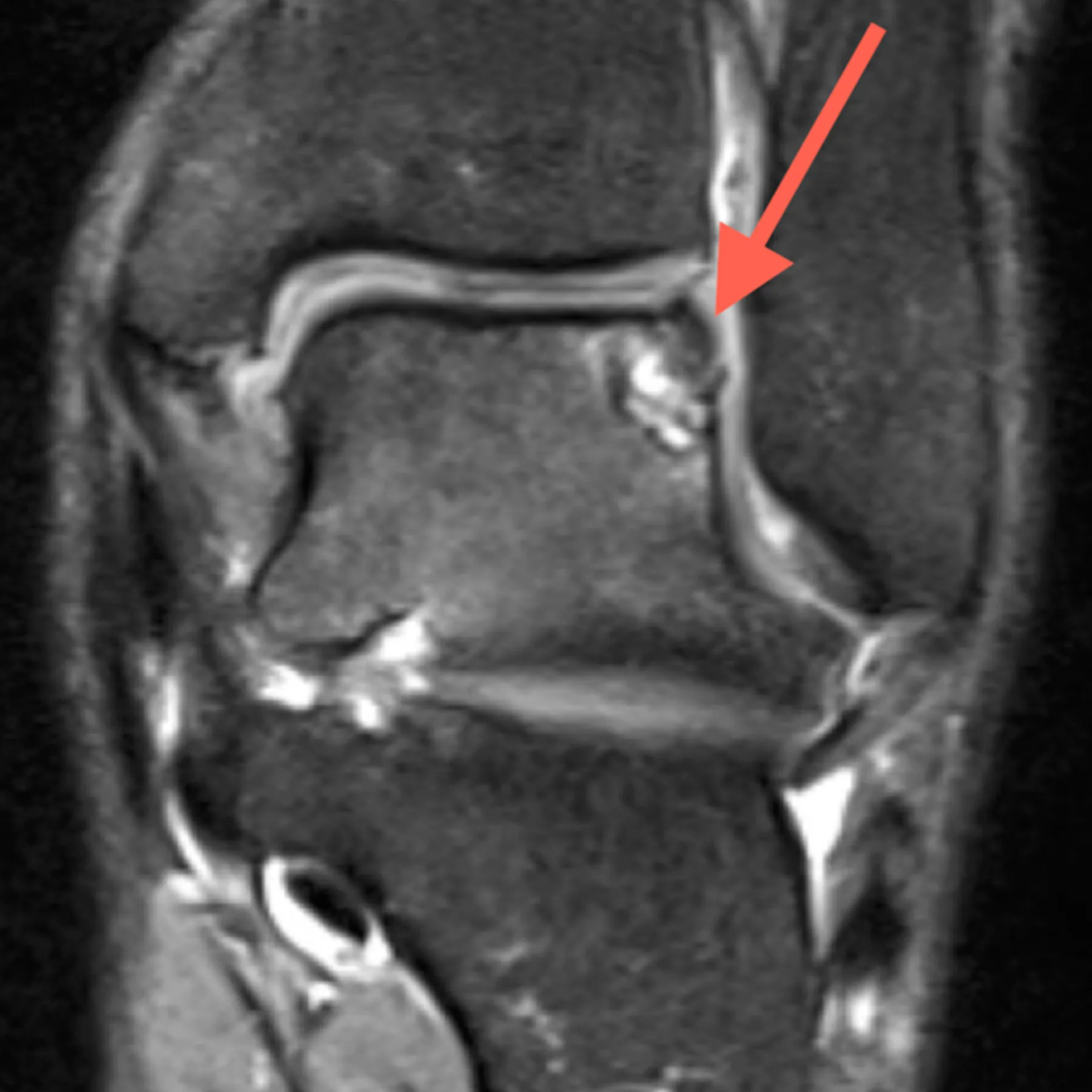 Osteocondritis Disecante del Tobillo