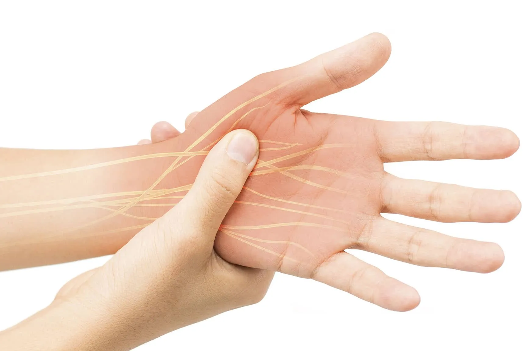 Síndrome del Túnel Carpiano (Nervio Mediano)