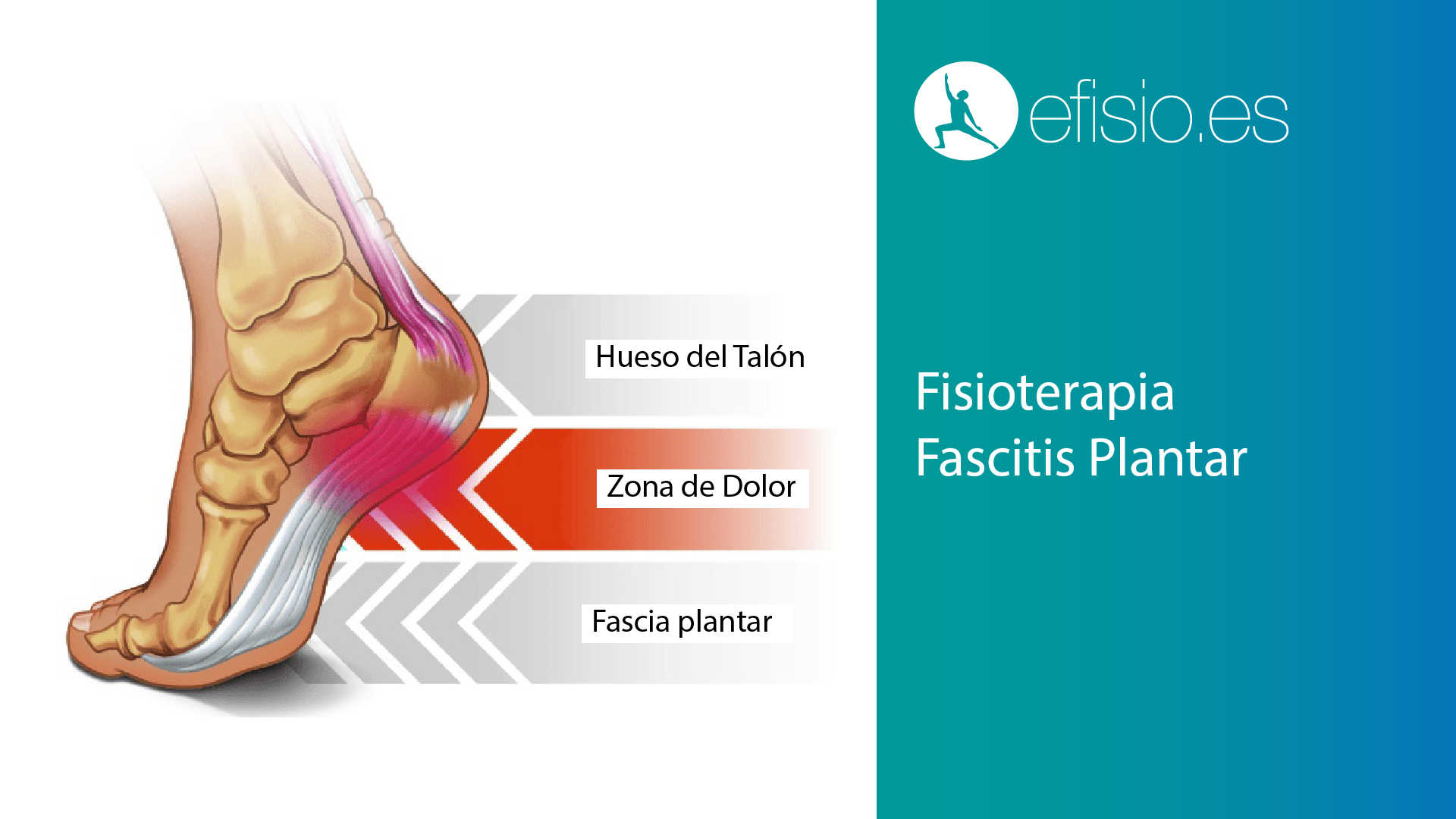 Fascitis Plantar: La Conexión Inesperada
